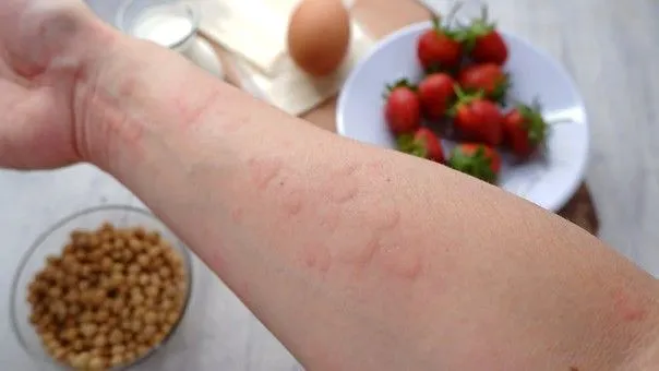 Allergies alimentaires chez l’adulte