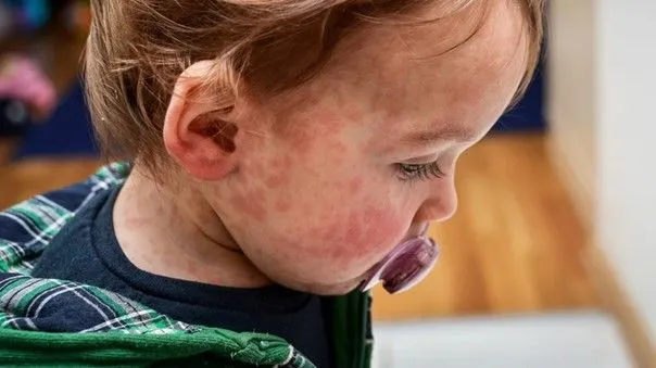 Allergies alimentaires chez l’enfant