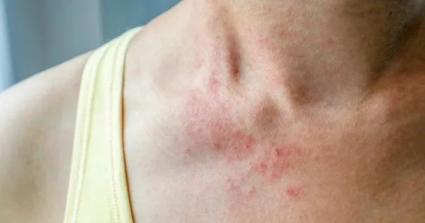 Allergies aux acariens