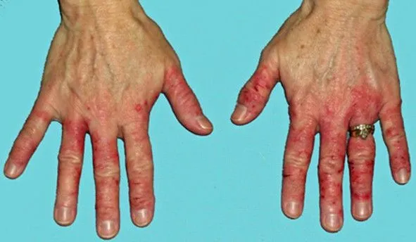Allergies aux anesthésiques