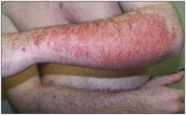 Allergies aux anti-inflammatoires