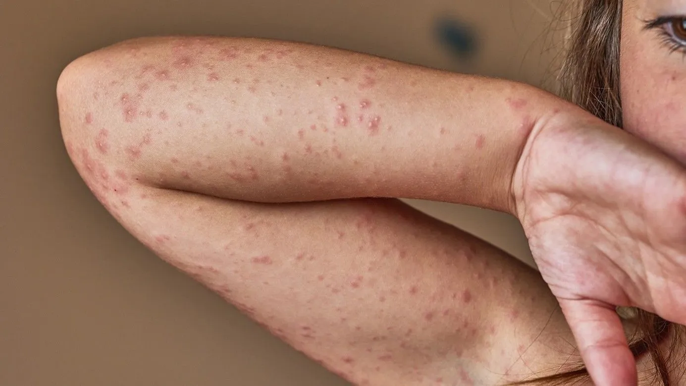Allergies aux antibiotiques
