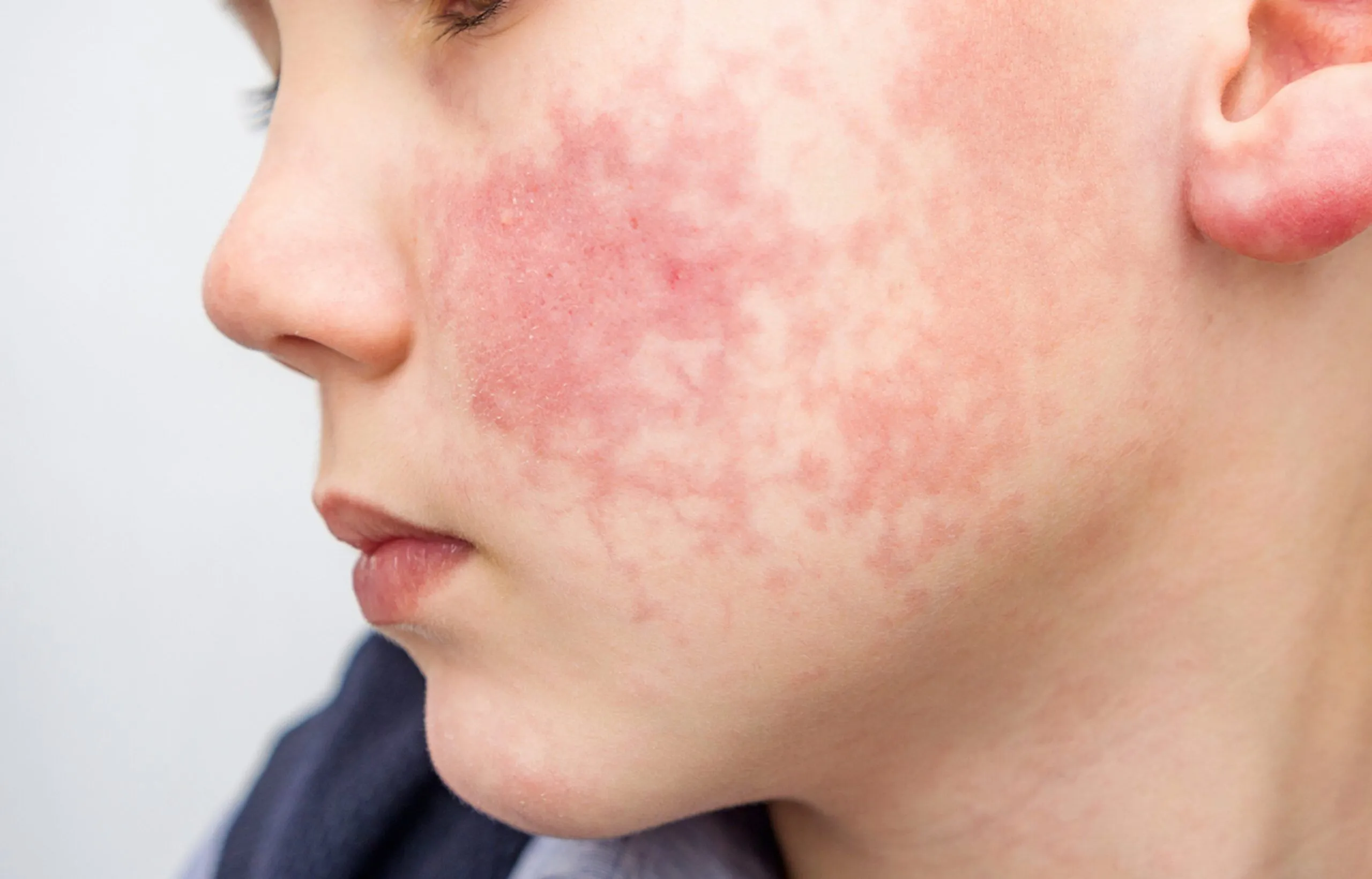 Allergies aux produits chimiques