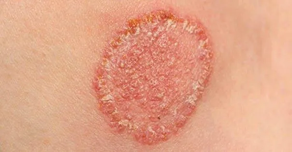 Candidose cutanée