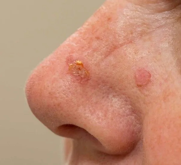 Carcinome basocellulaire (CBC)