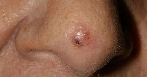 Carcinome épidermoïde