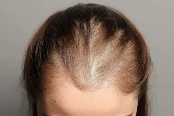 Chute de cheveux chronique