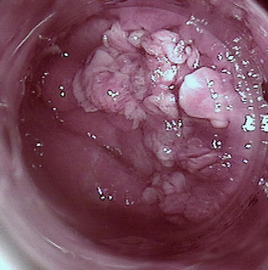 Condylomes acuminés (HPV)