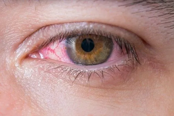 Conjonctivite allergique