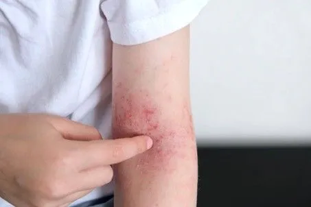 Dermatite atopique (eczéma atopique)