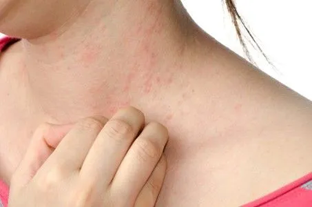 Dermatite de contact allergiqu