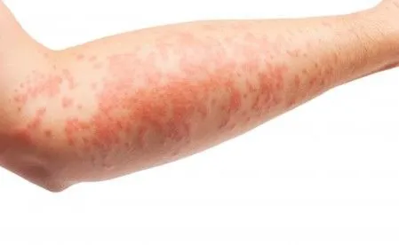 Dermatite de contact allergique