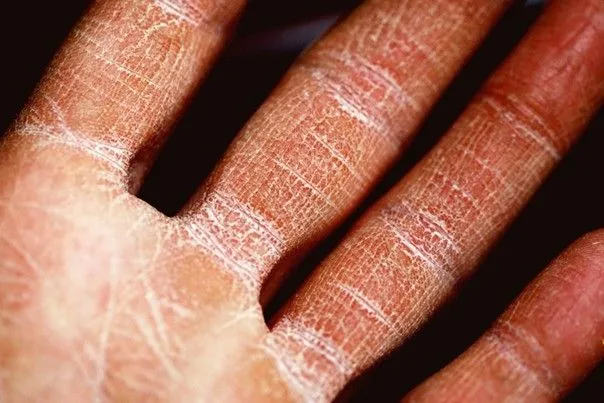 Dermatite de contact irritative