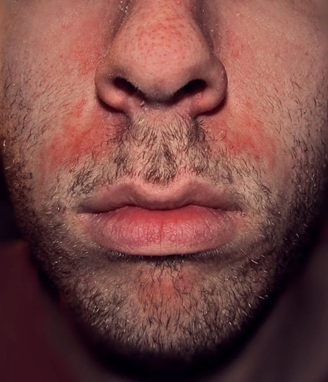 Dermatite séborrhéique