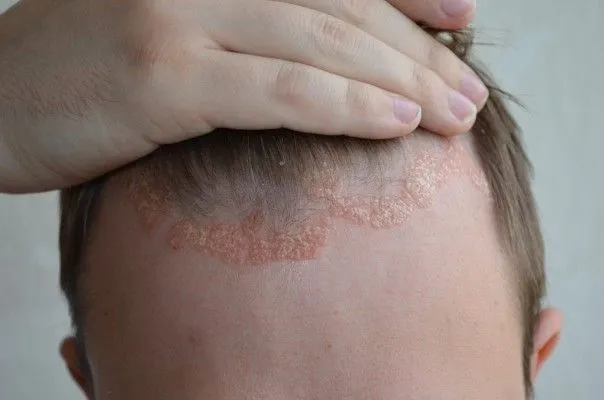 Dermatite séborrhéique du cuir chevelu