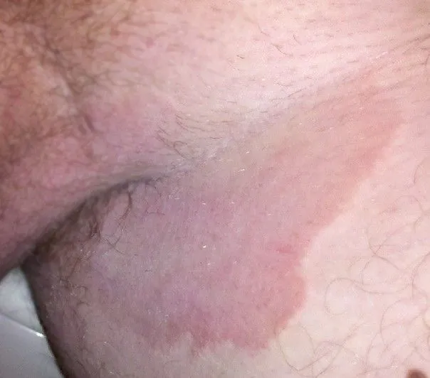 Dermatophytie de l’aine (tinea cruris)