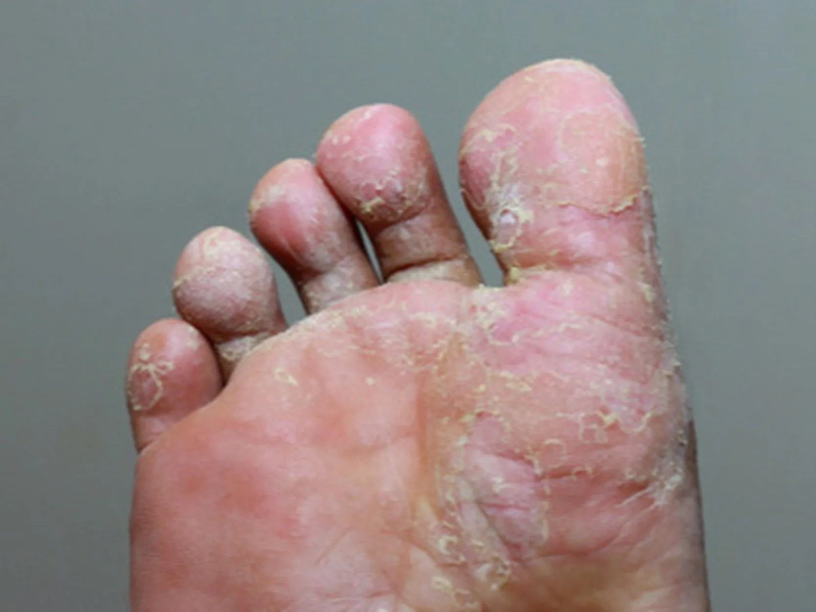 Dermatophytie des pieds (pied d’athlète – tinea pedis)