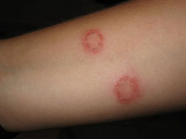 Dermatophytie du corps (tinea corporis)