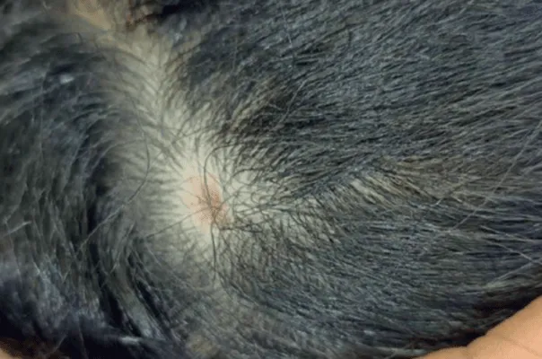 Dermatophytie du cuir chevelu (teigne)