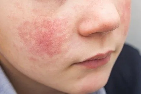 Érythème infectieux (Parvovirus B19)