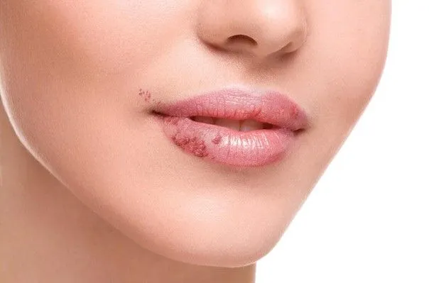 Herpès labial