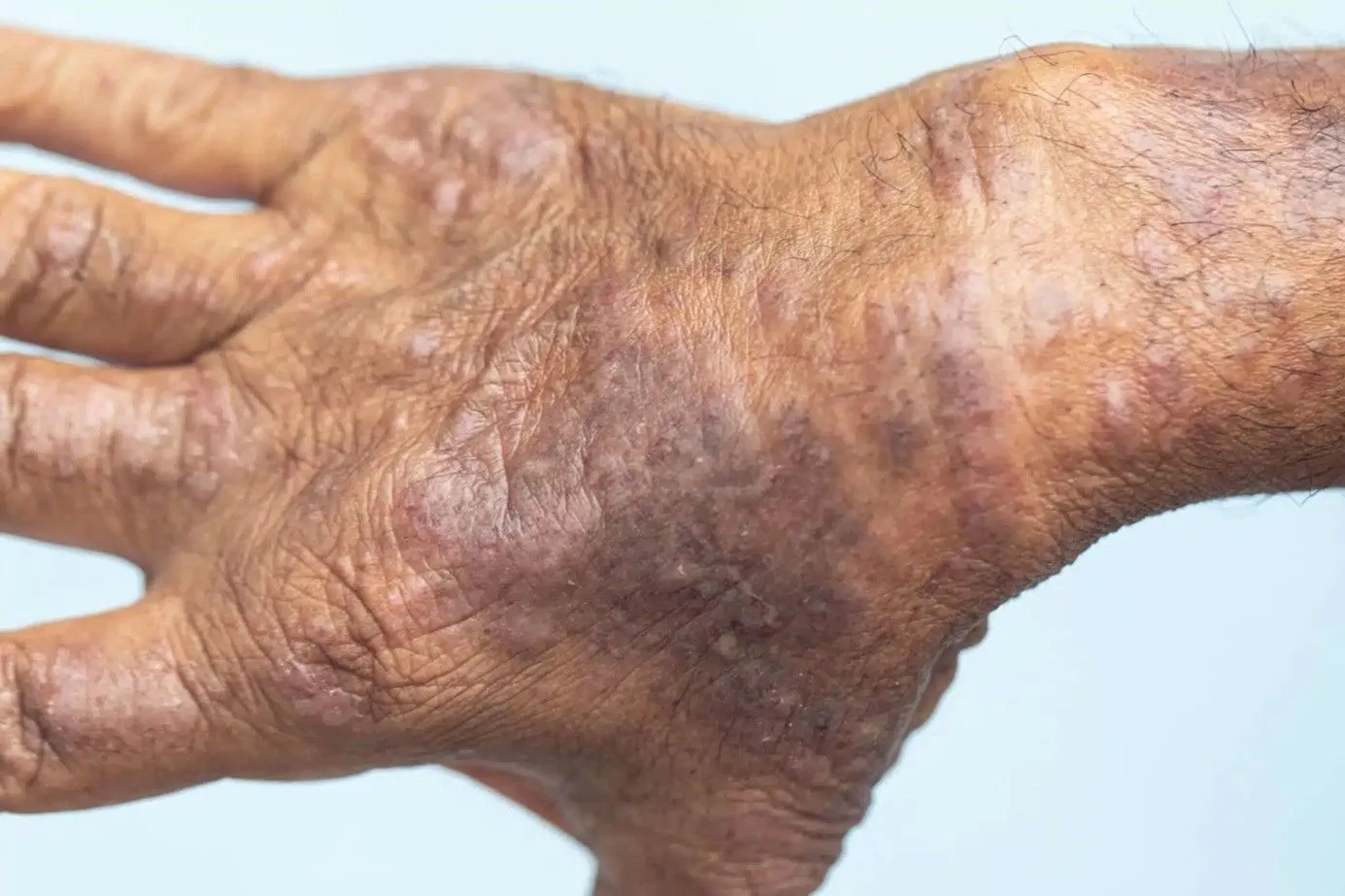 Hyperpigmentation post-inflammatoire (HPI)