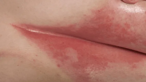 Intertrigo bactérien