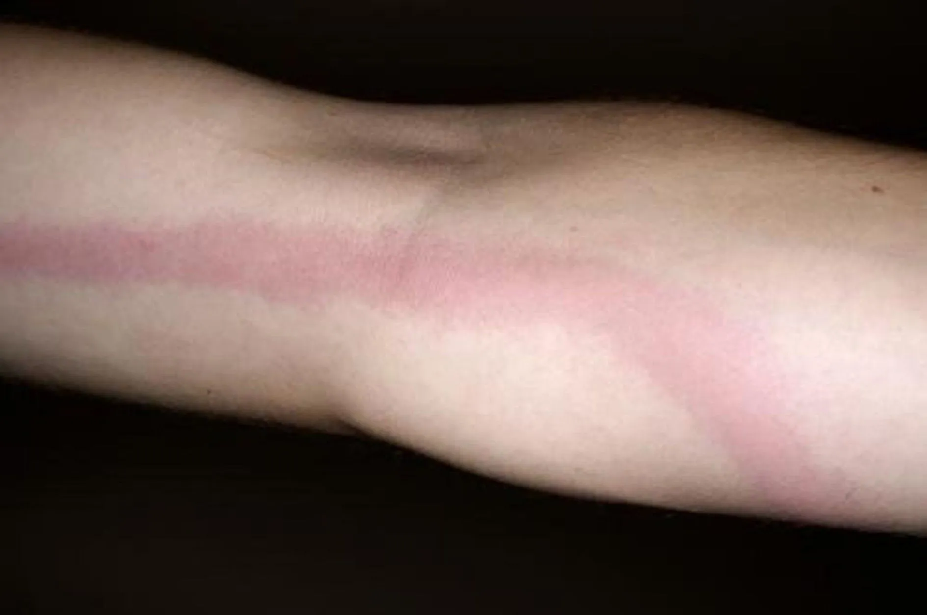Lymphangite bactérienne
