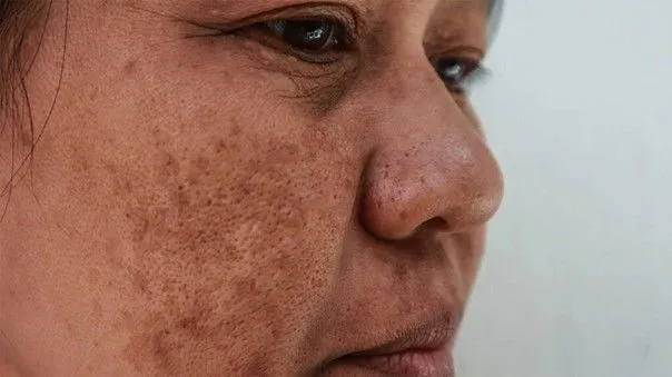 Mélasma (chloasma)