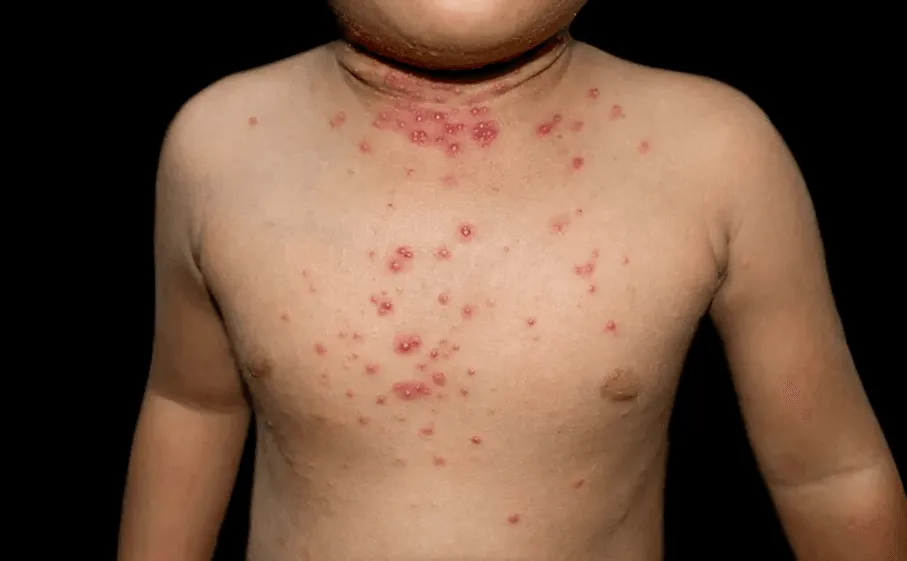 Molluscum contagiosum