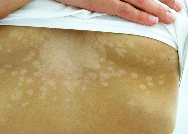Pityriasis versicolor