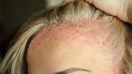 Psoriasis