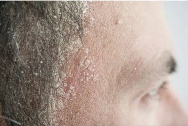 Psoriasis du cuir chevelu