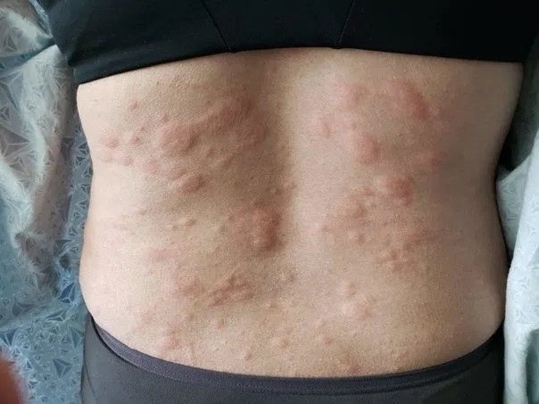 Réactions allergiques immédiates