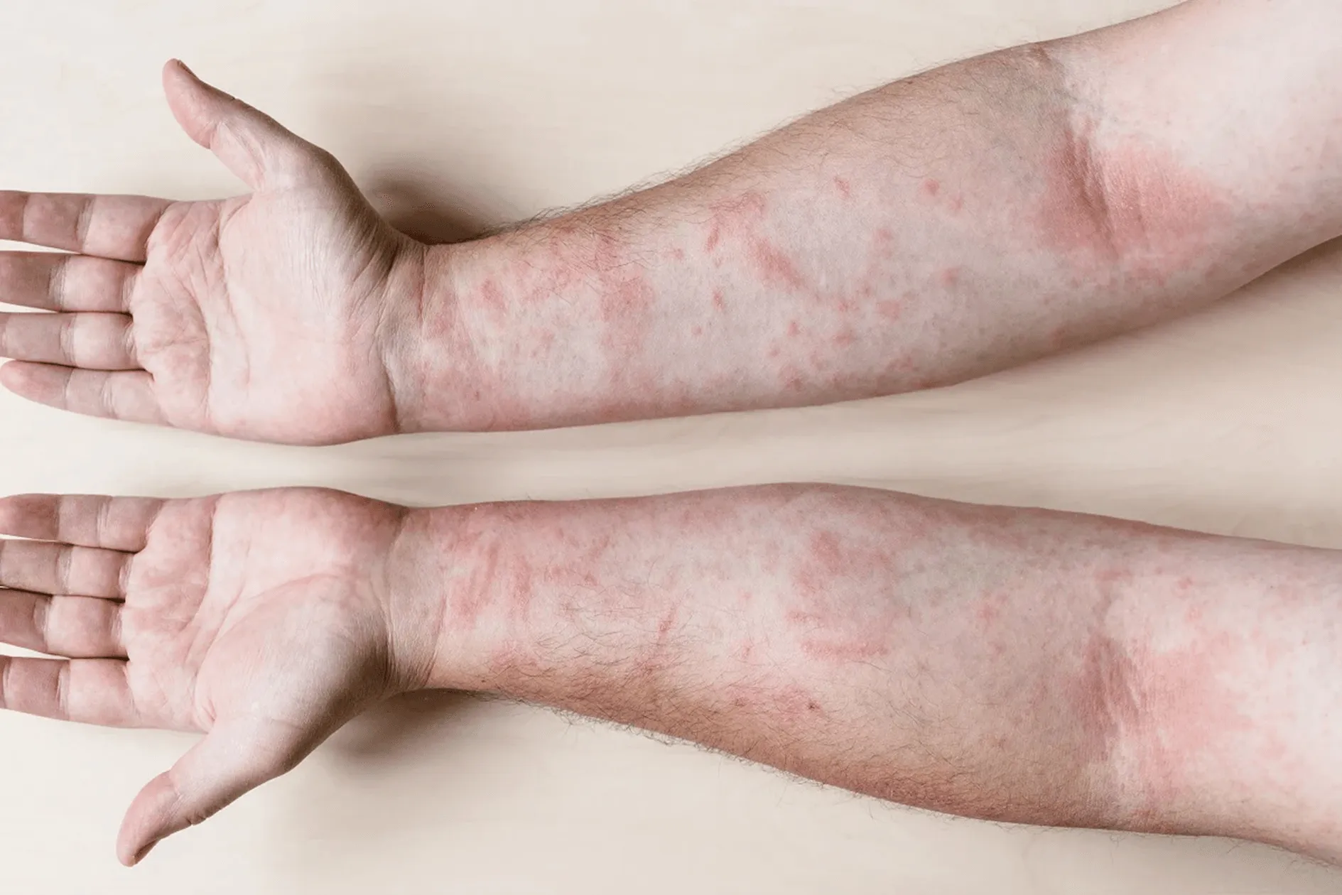 Réactions allergiques retardées