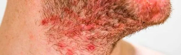 Tinea barbae (teigne de la barbe)
