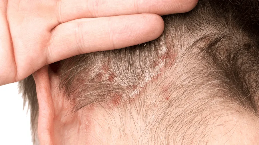 Troubles du cuir chevelu liés aux infections