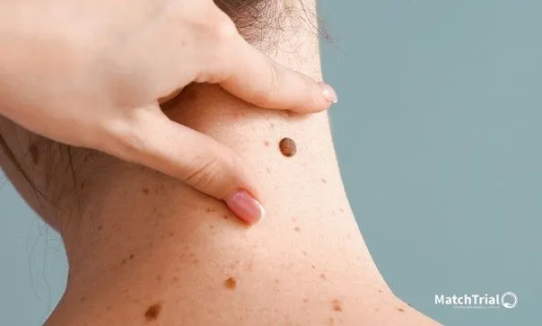 Tumeurs cutanées liées à l’immunodépression