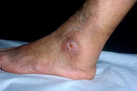 Ulcère cutané infecté