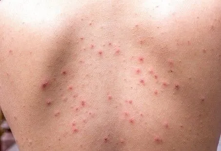 Varicelle
