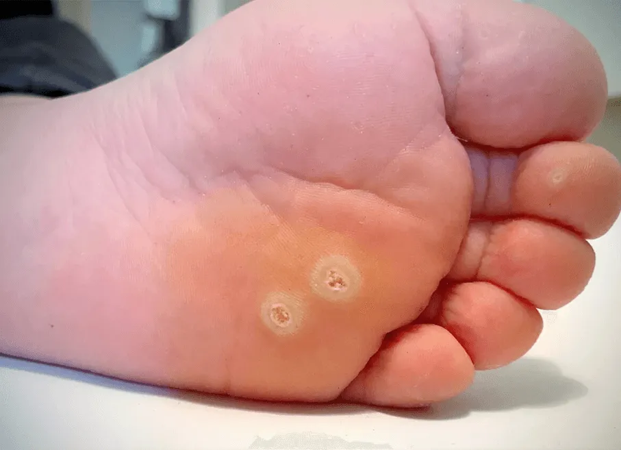 Verrues cutanées (HPV)