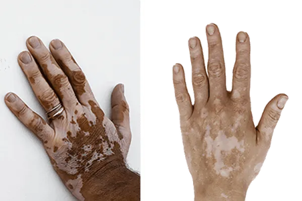 Vitiligo